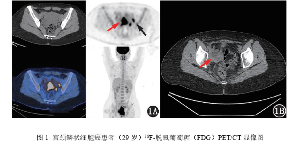 术前18F-FDG PET/CT 显像联合凝血功能参数预测早期宫颈癌复发