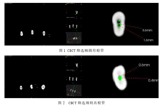 三种因素对根管桩道预备后根尖封闭性影响的思考