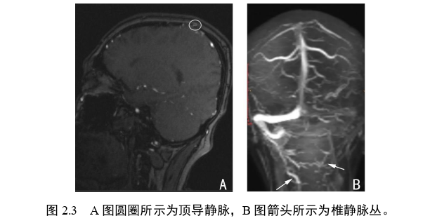 代颅内静脉窦血栓患者静脉循环代偿的临床及影像评价