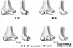 博士论文：成人肱骨外髁骨折研究进展