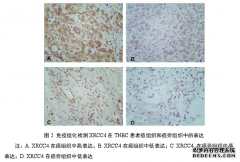 沉默XRCC4基因表达对三阴性乳腺癌放射治疗敏感性的医学影响