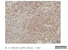 LZTFL1在胃癌等组织中的表达及其与不同黏附因子表达的医学相关性研究