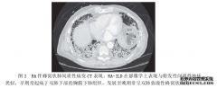 类风湿性关节炎合并肺部损害的相关因素分析及其硕士论文临床研究