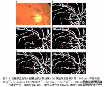 眼底计算机图像分割方法研究