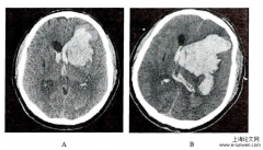 脑出血血肿增大及平扫CT征象相关性探究