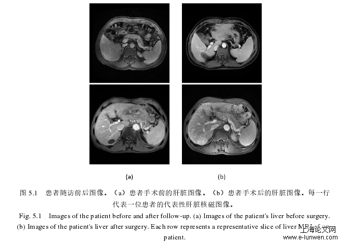 图 5.1   患者随访前后图像。（a）患者手术前的肝脏图像。（b）患者手术后的肝脏图像。每一行代表一位患者的代表性肝脏核磁图像。